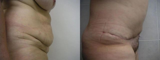 ABDOMIB PRED