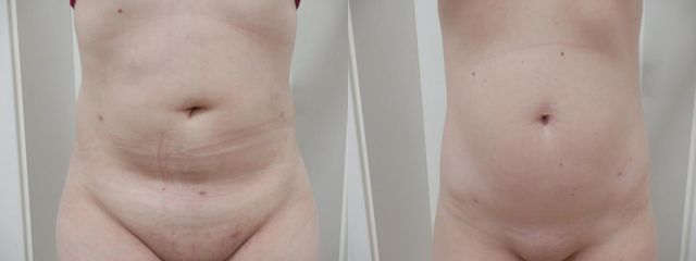 LIPO A