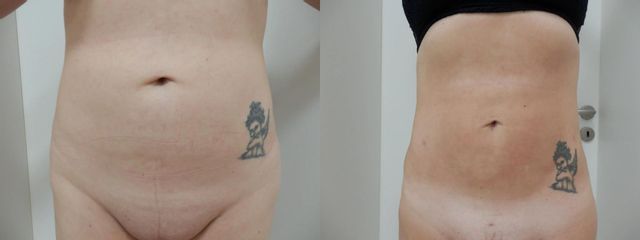 LIPOB PRED