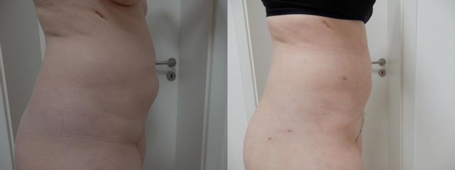 LIPOA PRED