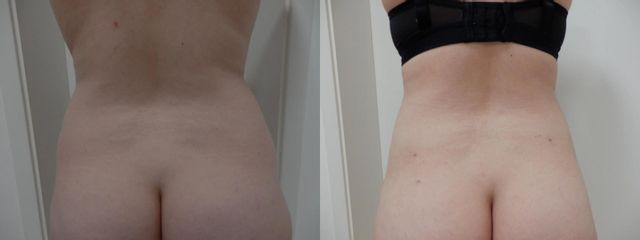 LIPOB PRED