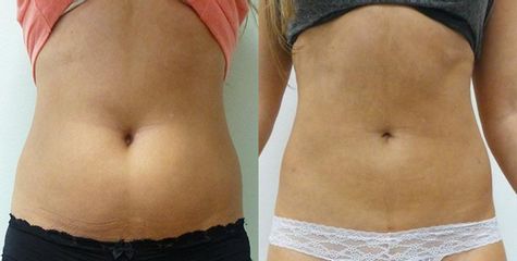 Liposukce tumescentní