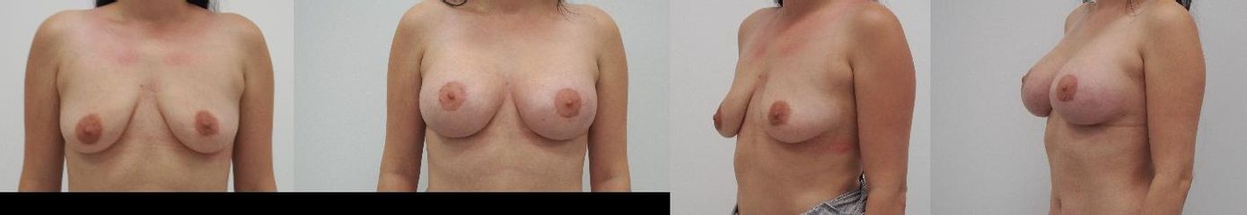 Augmentace vč. modelace