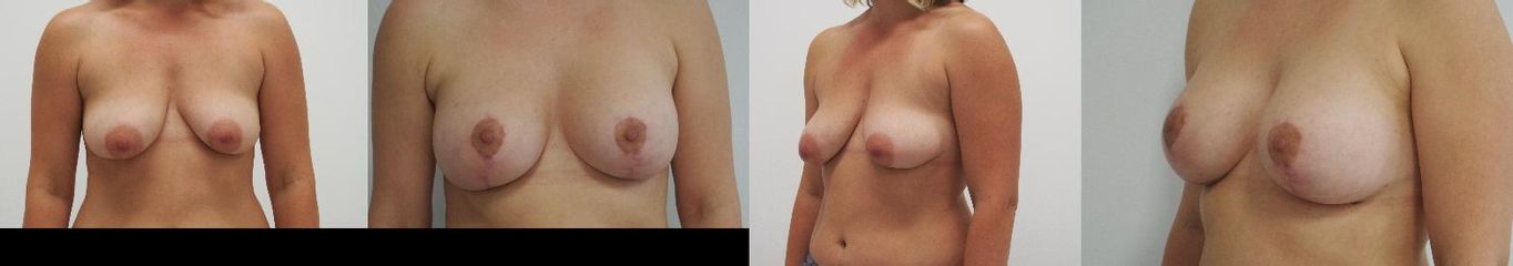Augmentace vč. modelace