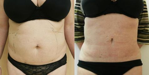 Liposukce tumescentní