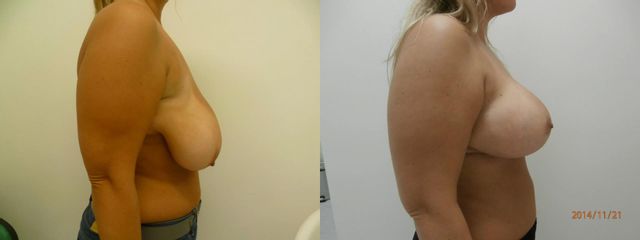 Modelace prsů