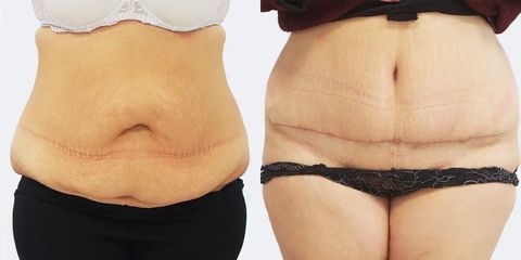 Abdominoplastika