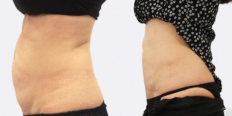 Miniabdominoplastika včetně liposukce