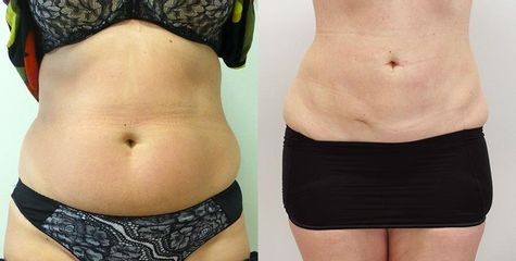 1434633045sp liposukce predek pred