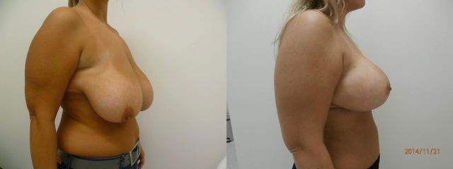 Modelace prsů