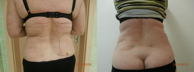 Liposukce tumescentní