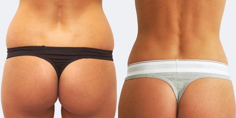 Liposukce - Prim. MUDr. Pavel Horyna - MEDICOM Clinic