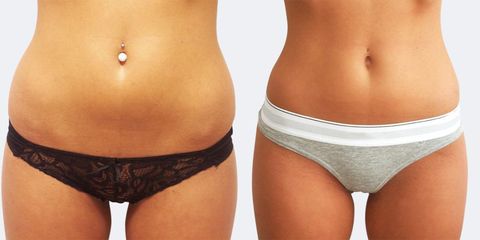 Liposukce - Prim. MUDr. Pavel Horyna - MEDICOM Clinic