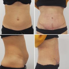 Abdominoplastika - Prim. MUDr. Pavel Horyna - MEDICOM Clinic