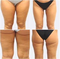 Liposukce - Prim. MUDr. Pavel Horyna - MEDICOM Clinic