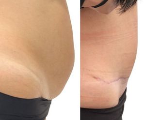 Abdominoplastika před a po - 880964
