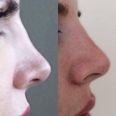 Nechirurgická korekce nosu - výplň na bázi kys. hyaluronové - MUDr. Zuzana Poláková