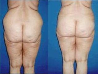 lipo5 pred