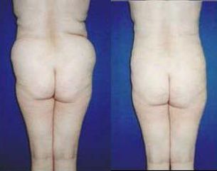 lipo6 pred