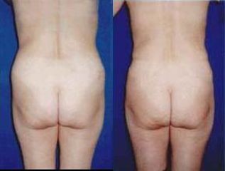 lipo7 pred