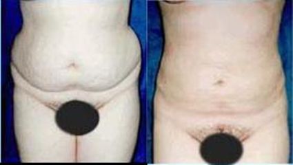 lipo8 pred