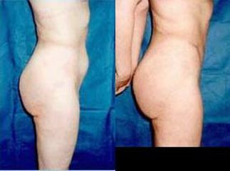 lipo10 pred