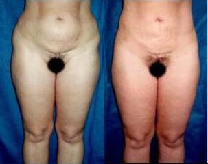 lipo14 pred