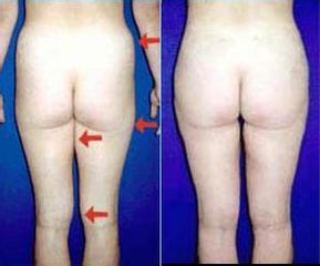 lipo15 pred