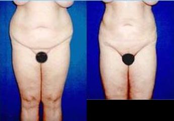 lipo9 pred