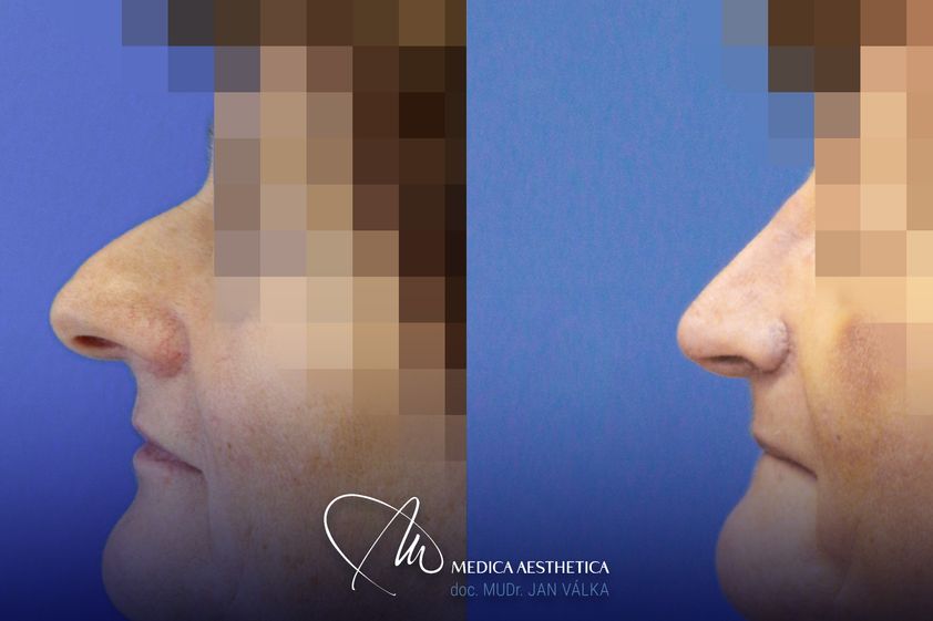 Rhinoplastika před a po - 873337