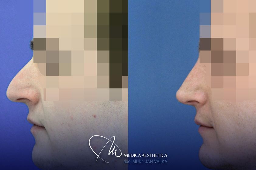 Rhinoplastika před a po - 873339