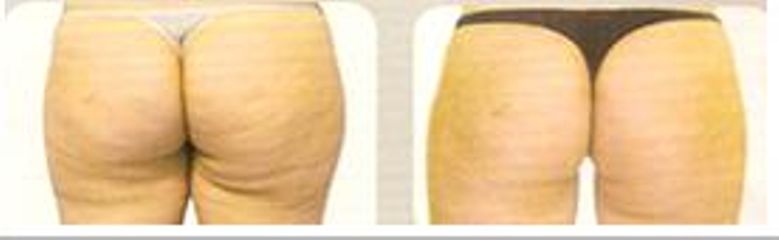 lipo