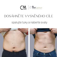 Neinvazivní liposukce - MUDr. Radan Vidura, Ph.D. - RVmedCentrum