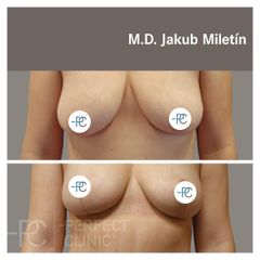 Modelace prsou - MUDr. Jakub Miletín