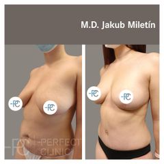 Abdominoplastika - MUDr. Jakub Miletín
