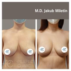 Modelace prsou - MUDr. Jakub Miletín
