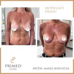 Modelace prsou - MUDr. Marek Bortlíček
