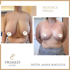 Zmenšení prsou - MUDr. Marek Bortlíček