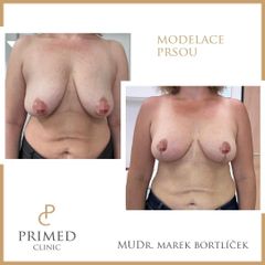 Modelace prsou - MUDr. Marek Bortlíček