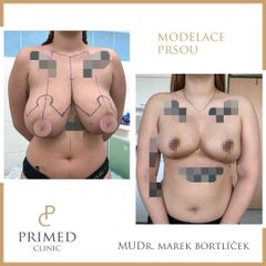 Modelace prsou - MUDr. Marek Bortlíček