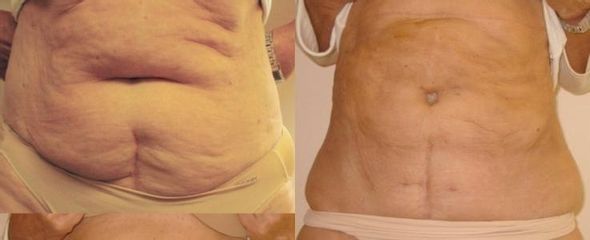 Frajer laserova lipo