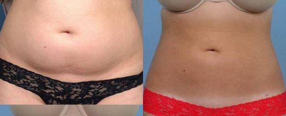 Frajer slimlipo