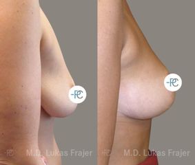 Modelace prsou - MUDr. Lukáš Frajer - Perfect Clinic