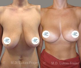 Modelace prsou - MUDr. Lukáš Frajer - Perfect Clinic