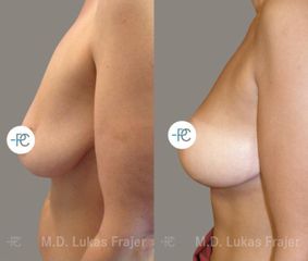 Modelace prsou - MUDr. Lukáš Frajer - Perfect Clinic