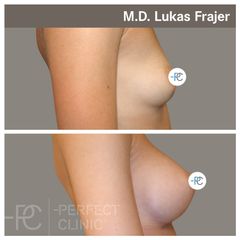 Zvětšení prsou - MUDr. Lukáš Frajer - Perfect Clinic