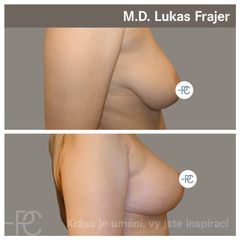 Modelace prsou - MUDr. Lukáš Frajer - Perfect Clinic