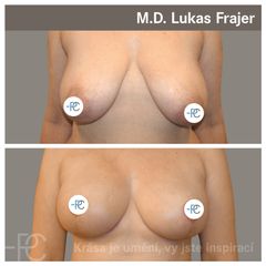 Modelace prsou - MUDr. Lukáš Frajer - Perfect Clinic
