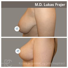 Modelace prsou - MUDr. Lukáš Frajer - Perfect Clinic
