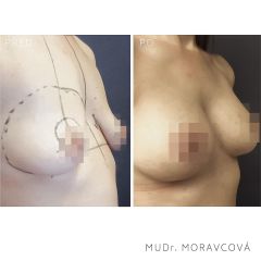 Zvětšení prsou - MUDr. Petra Moravcová